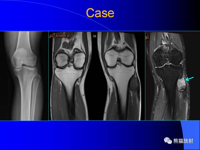 【PPT】膝关节周围囊肿MRI 【PPT】膝关节周围囊肿MRI