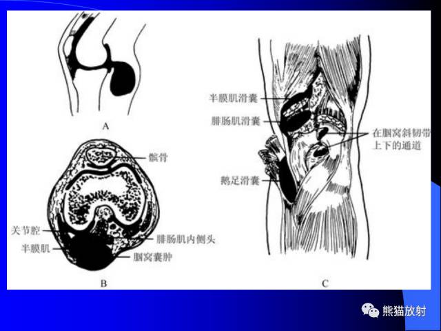 【PPT】膝关节周围囊肿MRI 【PPT】膝关节周围囊肿MRI