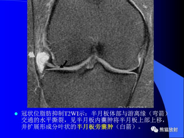 【PPT】膝关节周围囊肿MRI 【PPT】膝关节周围囊肿MRI