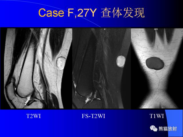 【PPT】膝关节周围囊肿MRI 【PPT】膝关节周围囊肿MRI