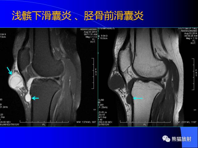 【PPT】膝关节周围囊肿MRI 【PPT】膝关节周围囊肿MRI