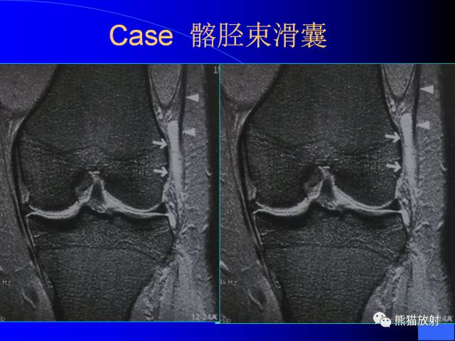 【PPT】膝关节周围囊肿MRI 【PPT】膝关节周围囊肿MRI