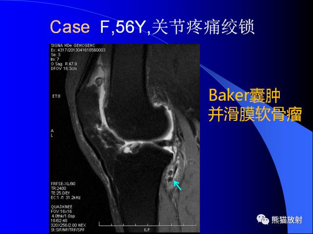 【PPT】膝关节周围囊肿MRI 【PPT】膝关节周围囊肿MRI