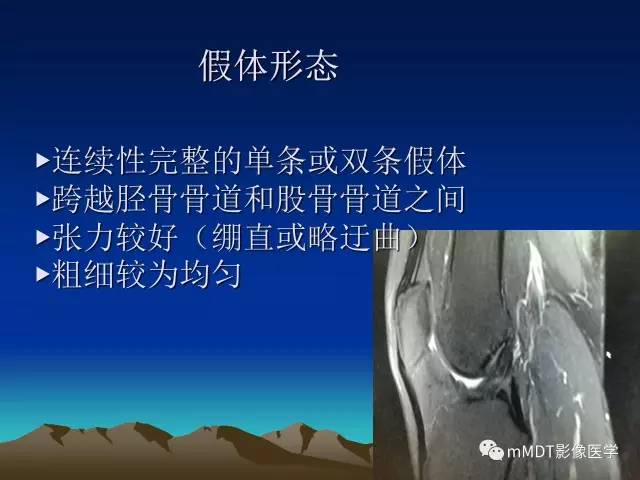 【PPT】前交叉韧带重建术后的MRI评价