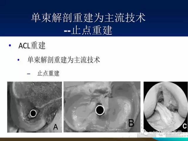 【PPT】前交叉韧带重建术后的MRI评价