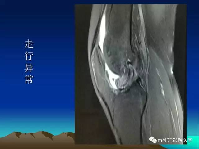 【PPT】前交叉韧带重建术后的MRI评价