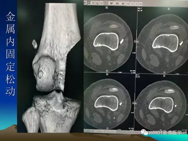 【PPT】前交叉韧带重建术后的MRI评价