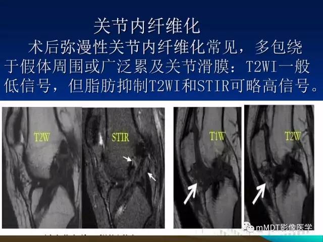【PPT】前交叉韧带重建术后的MRI评价