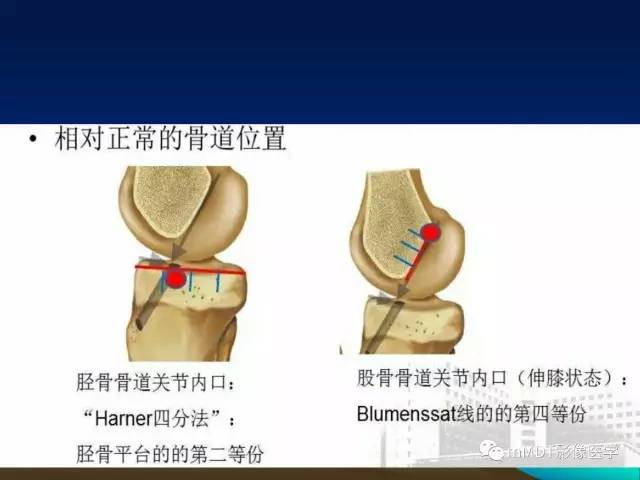 【PPT】前交叉韧带重建术后的MRI评价