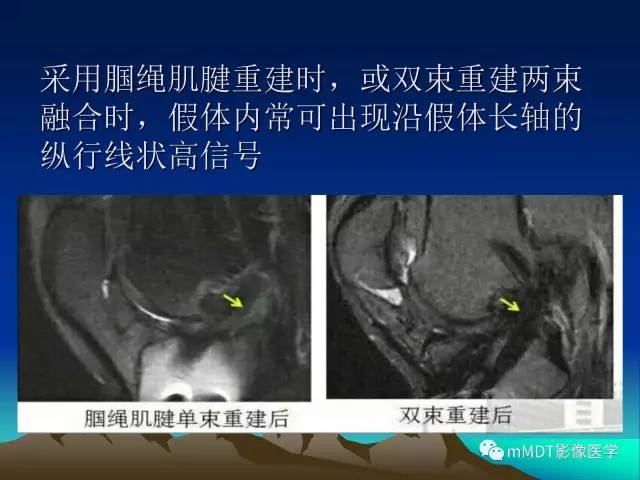 【PPT】前交叉韧带重建术后的MRI评价