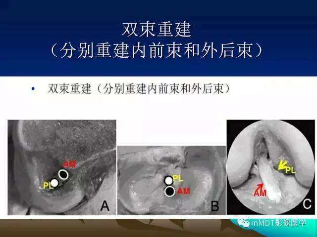 【PPT】前交叉韧带重建术后的MRI评价