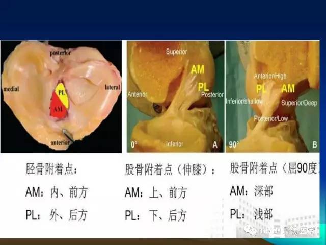 【PPT】前交叉韧带重建术后的MRI评价
