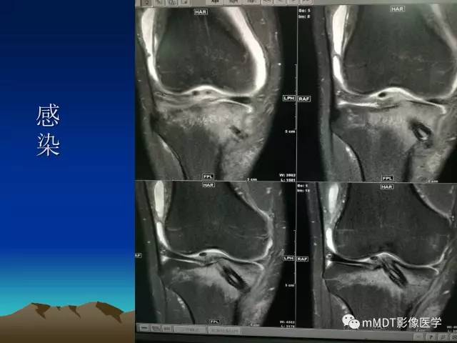 【PPT】前交叉韧带重建术后的MRI评价