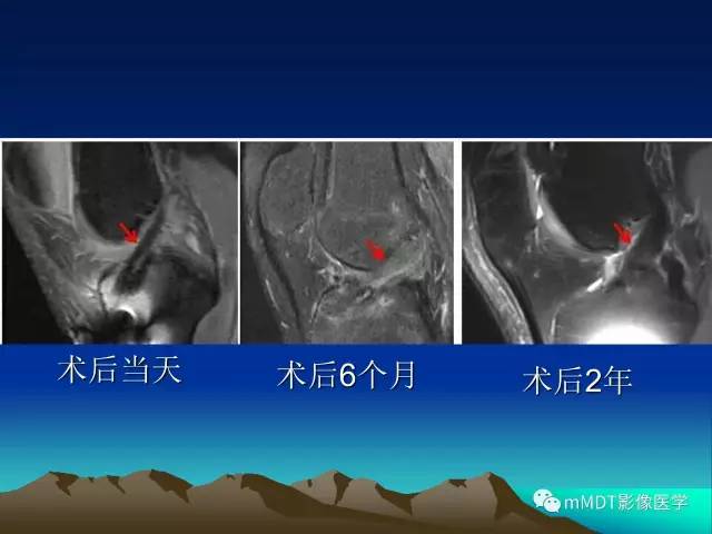 【PPT】前交叉韧带重建术后的MRI评价
