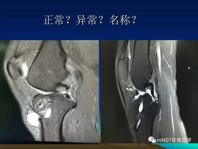 【PPT】前交叉韧带重建术后的MRI评价