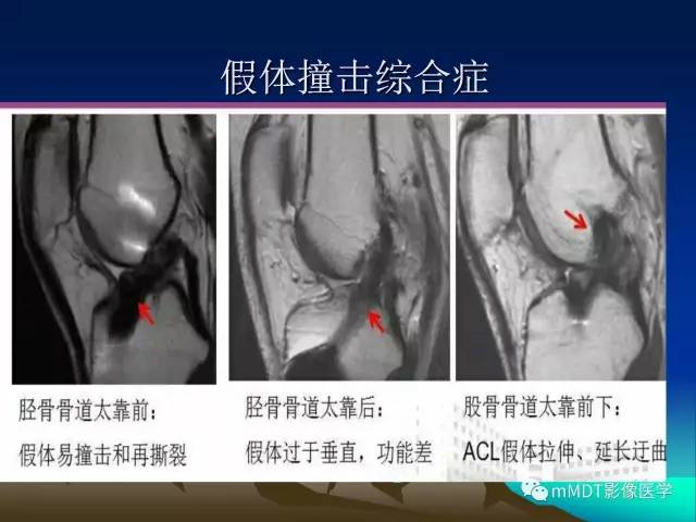 【PPT】前交叉韧带重建术后的MRI评价