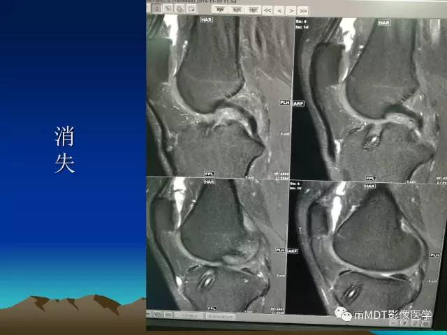 【PPT】前交叉韧带重建术后的MRI评价