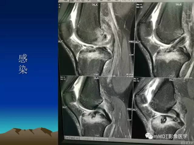 【PPT】前交叉韧带重建术后的MRI评价