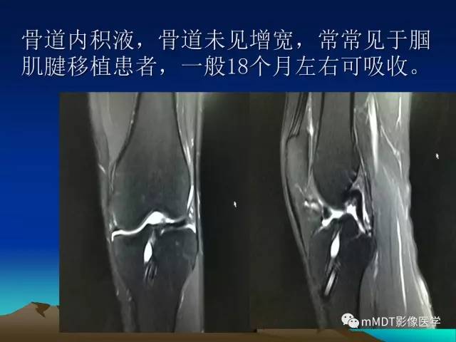 【PPT】前交叉韧带重建术后的MRI评价