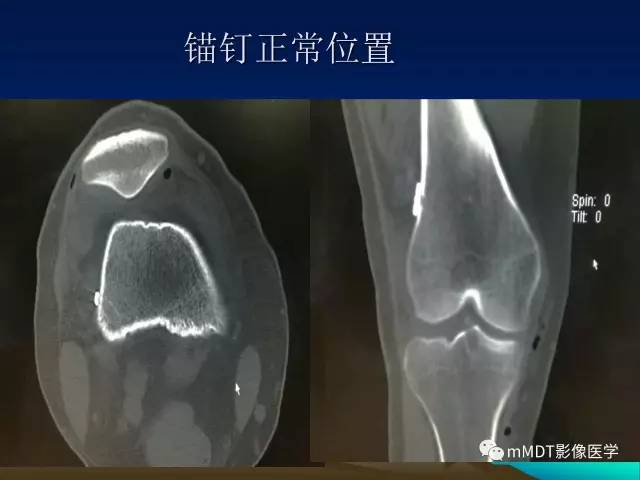 【PPT】前交叉韧带重建术后的MRI评价