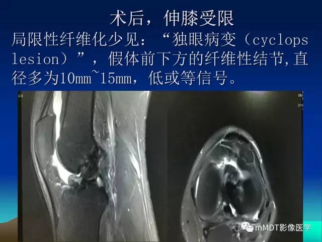 【PPT】前交叉韧带重建术后的MRI评价