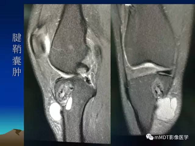 【PPT】前交叉韧带重建术后的MRI评价