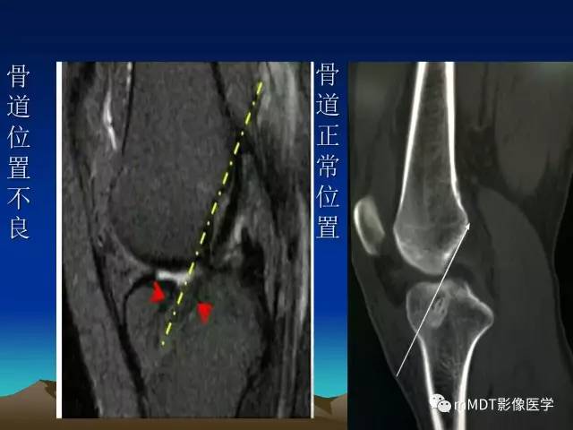 【PPT】前交叉韧带重建术后的MRI评价