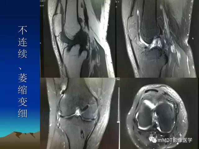 【PPT】前交叉韧带重建术后的MRI评价