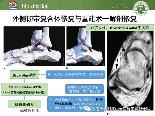 【PPT】踝及足术后CT和MR成像