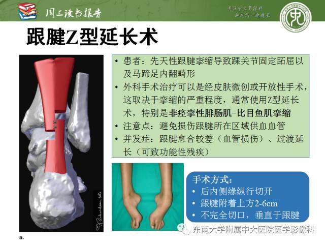 【PPT】踝及足术后CT和MR成像
