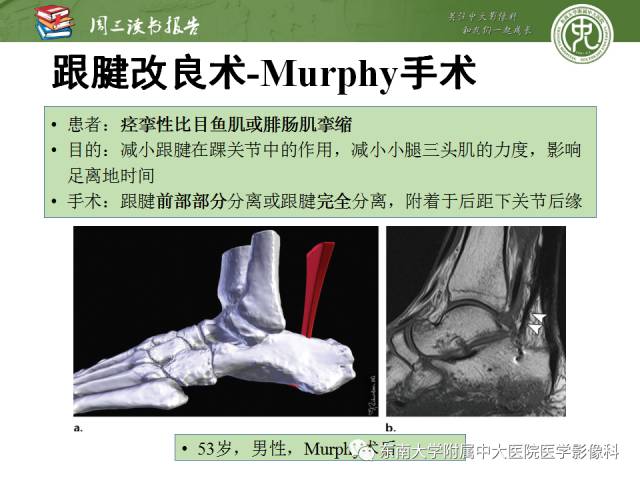 【PPT】踝及足术后CT和MR成像