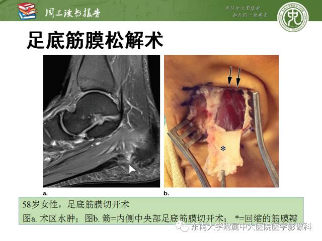 【PPT】踝及足术后CT和MR成像