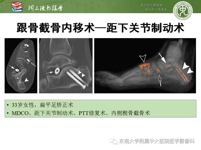 【PPT】踝及足术后CT和MR成像