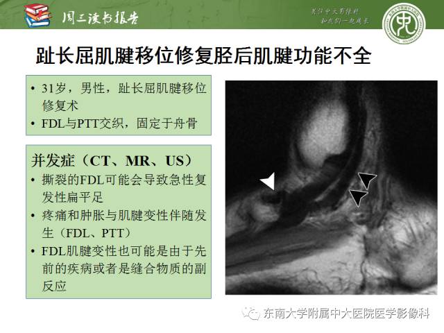 【PPT】踝及足术后CT和MR成像