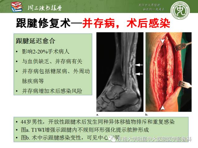 【PPT】踝及足术后CT和MR成像