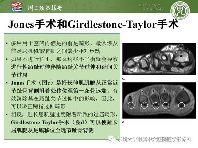 【PPT】踝及足术后CT和MR成像