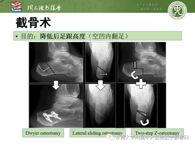 【PPT】踝及足术后CT和MR成像