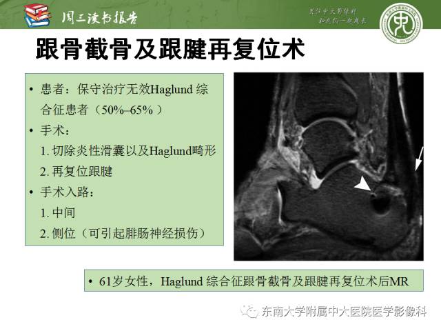【PPT】踝及足术后CT和MR成像