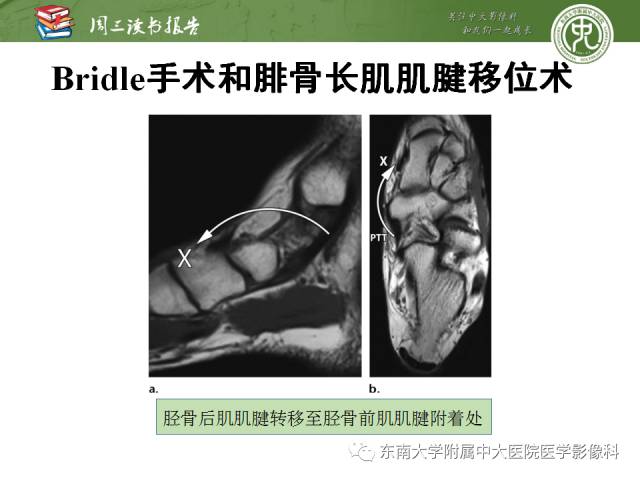 【PPT】踝及足术后CT和MR成像