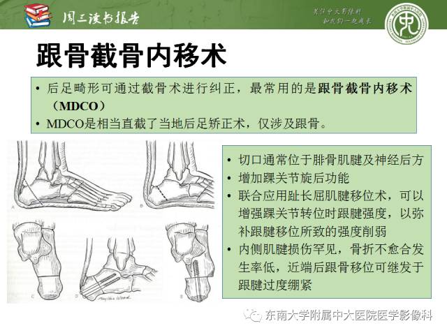 【PPT】踝及足术后CT和MR成像