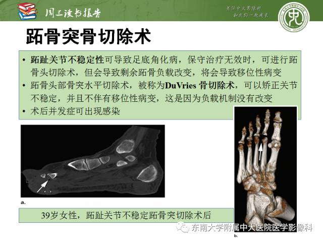 【PPT】踝及足术后CT和MR成像