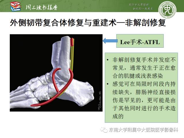 【PPT】踝及足术后CT和MR成像