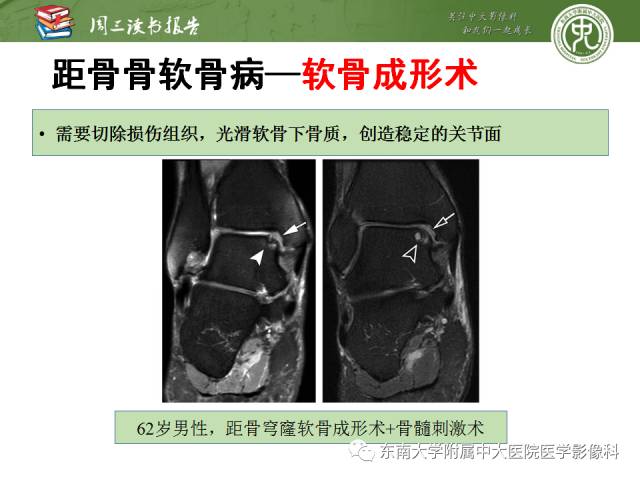 【PPT】踝及足术后CT和MR成像