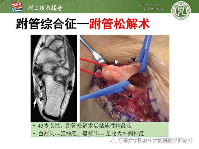 【PPT】踝及足术后CT和MR成像