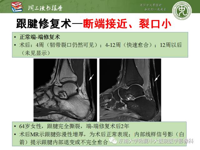 【PPT】踝及足术后CT和MR成像