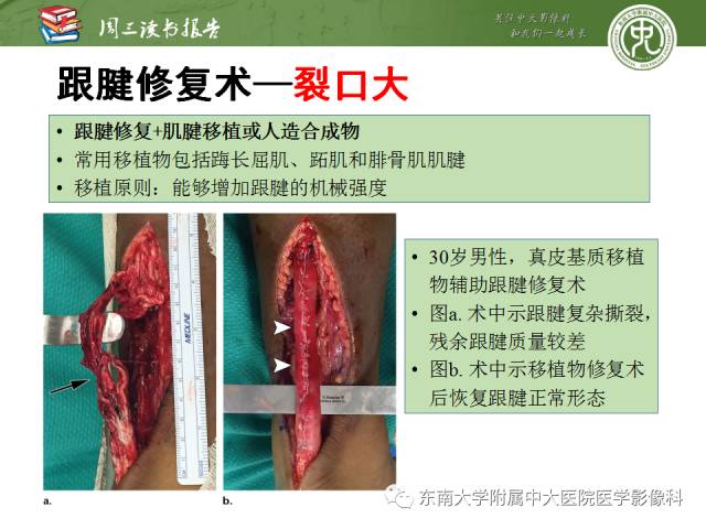 【PPT】踝及足术后CT和MR成像