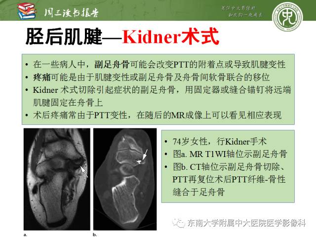 【PPT】踝及足术后CT和MR成像