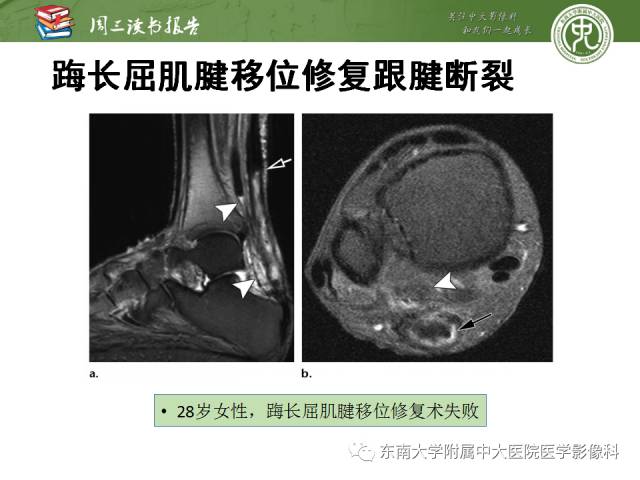 【PPT】踝及足术后CT和MR成像
