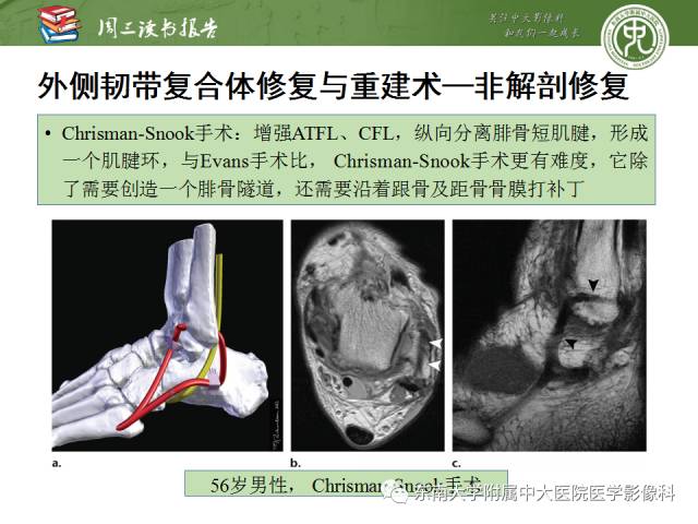 【PPT】踝及足术后CT和MR成像