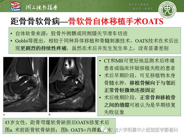【PPT】踝及足术后CT和MR成像